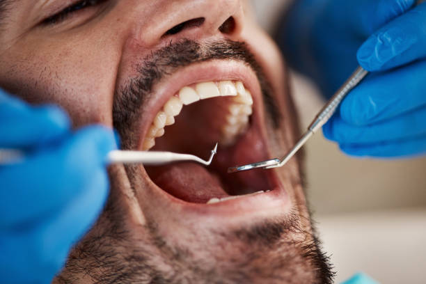 Best Emergency Dental Care for Broken or Chipped Teeth in Fullerton, CA