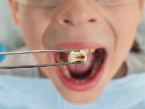 Best Emergency Tooth Extraction in Fullerton, CA